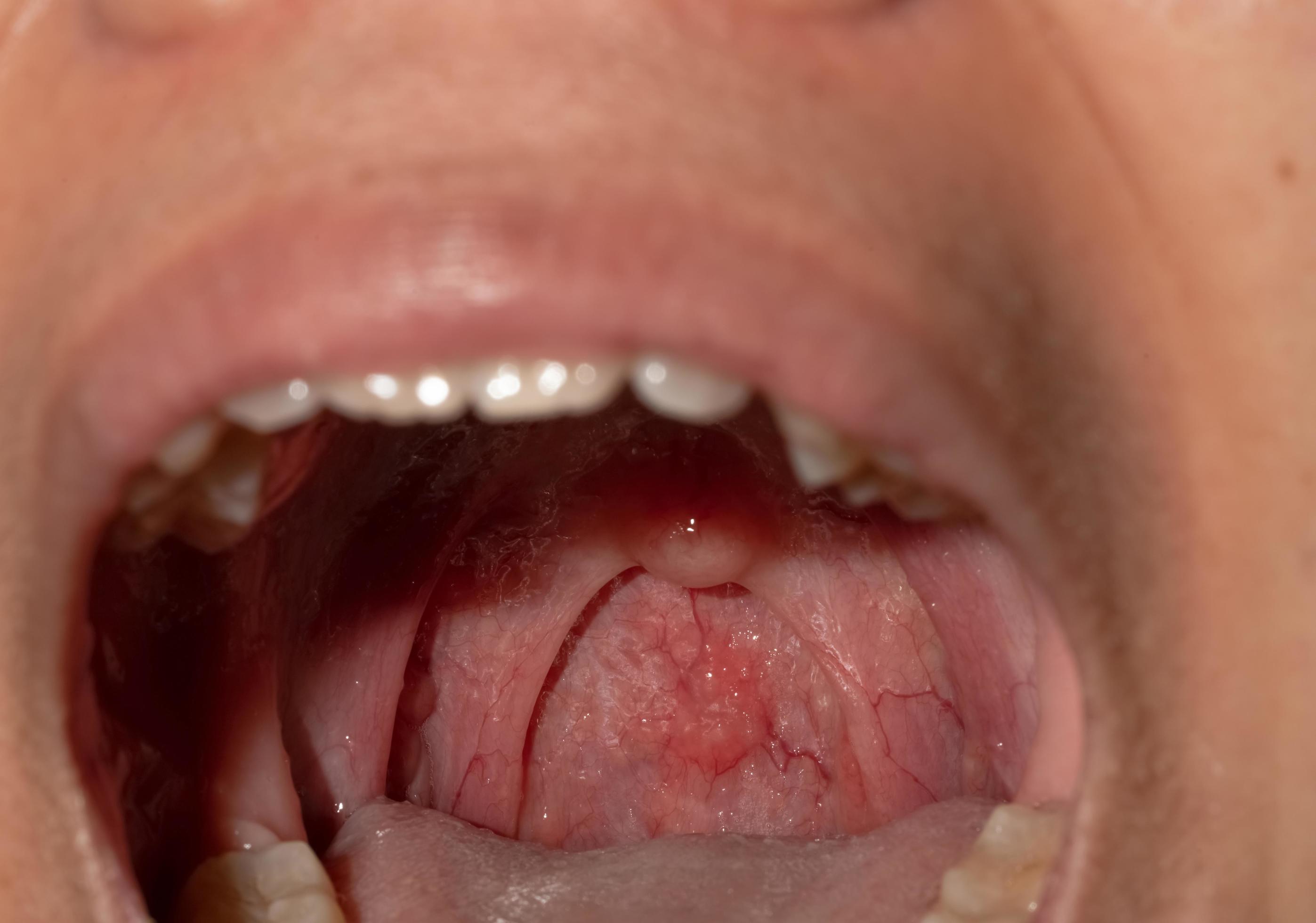 Sore throat with throat swollen. Closeup open mouth with posterior