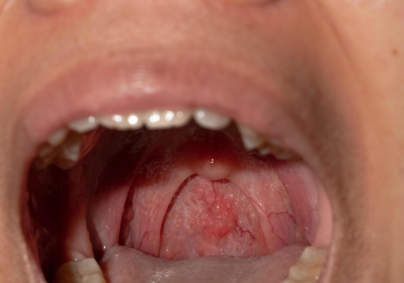 Sore throat with throat swollen. Closeup open mouth with posterior pharyngeal wall swelling and uvula and tonsil. Influenza follicles in the posterior pharyngeal wall. Upper respiratory tract. photo