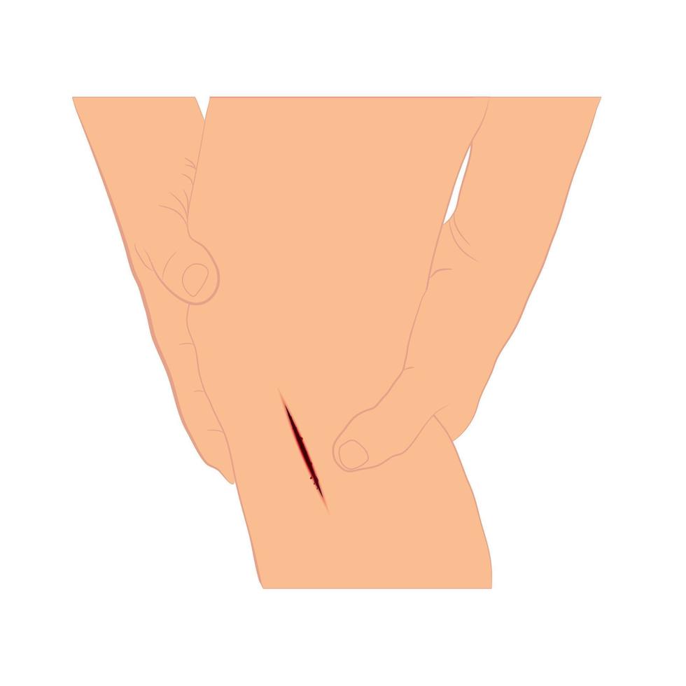 injured leg with bleeding gash with wound on the leg vector illustration