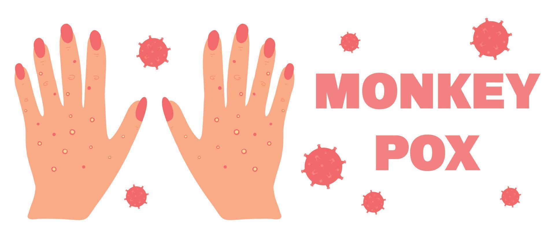 Banner with smallpox monkey. Monkeypox. Hands with a rash. Smallpox symptom. Vector illustration.