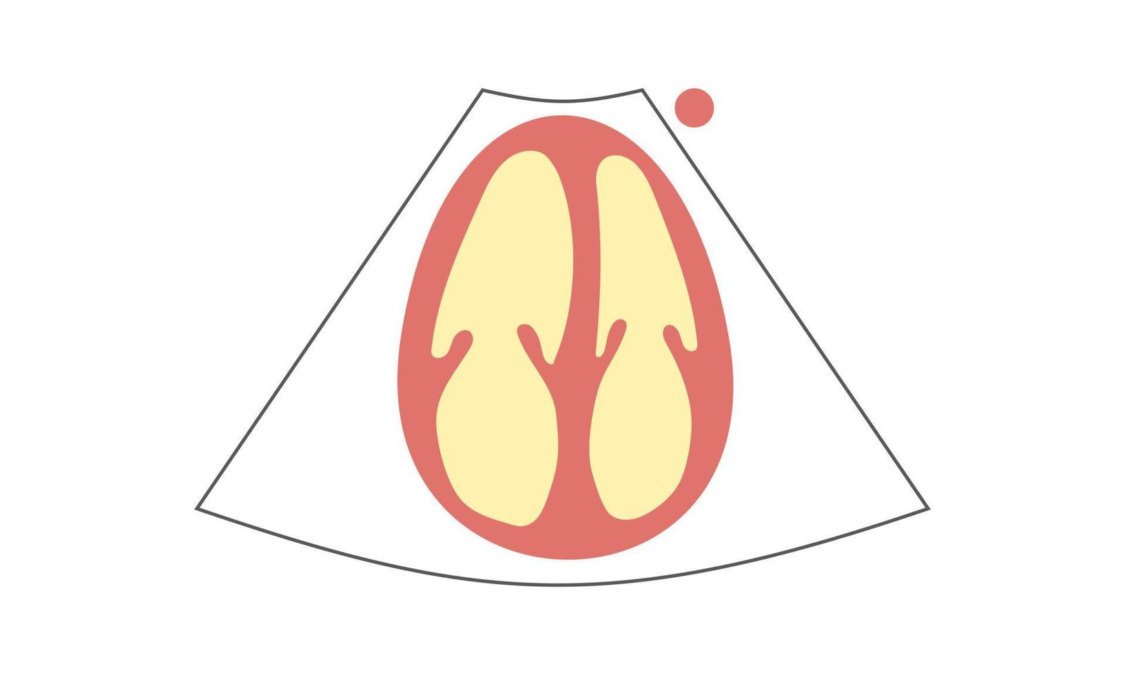 Diagram of right Ventricle enlargement of Apical 4-Chamber View of Echocardiography. Healthcare Concept vector