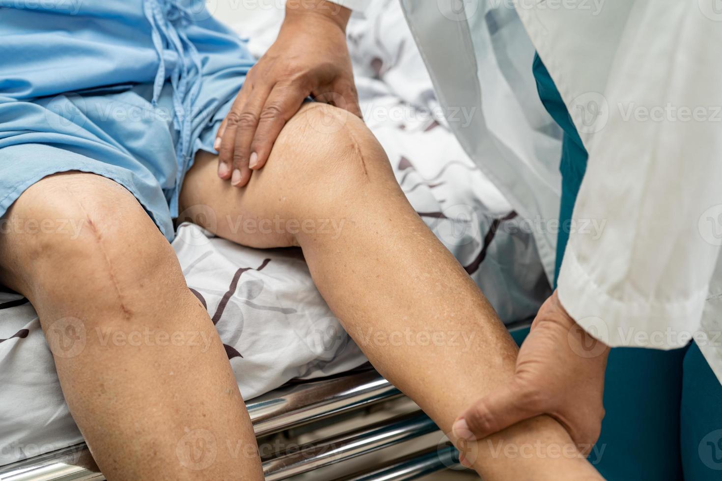 Asian senior or elderly old lady woman patient show her scars surgical total knee joint replacement Suture wound surgery arthroplasty on bed in nursing hospital ward, healthy strong medical concept. photo