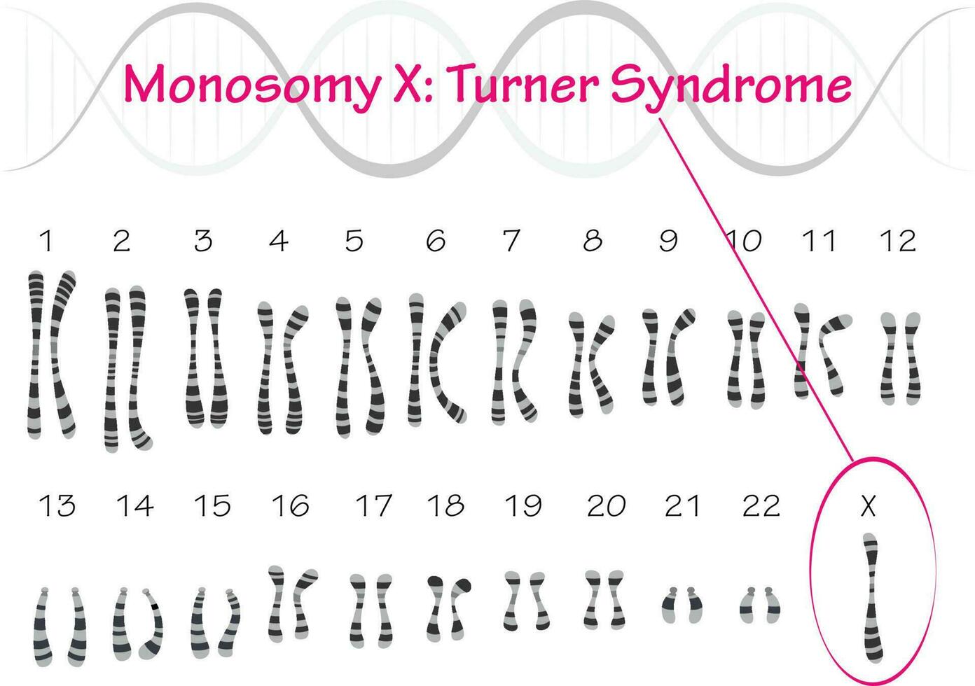 Turner Syndrome Karyotype Monosomy X 7818638 Vector Art at Vecteezy