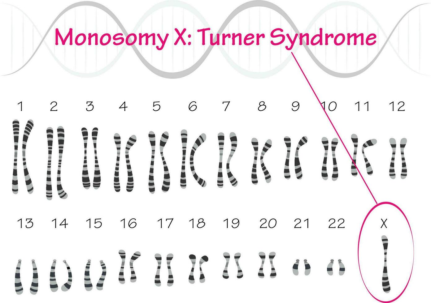 Turner Syndrome Karyotype Monosomy X vector