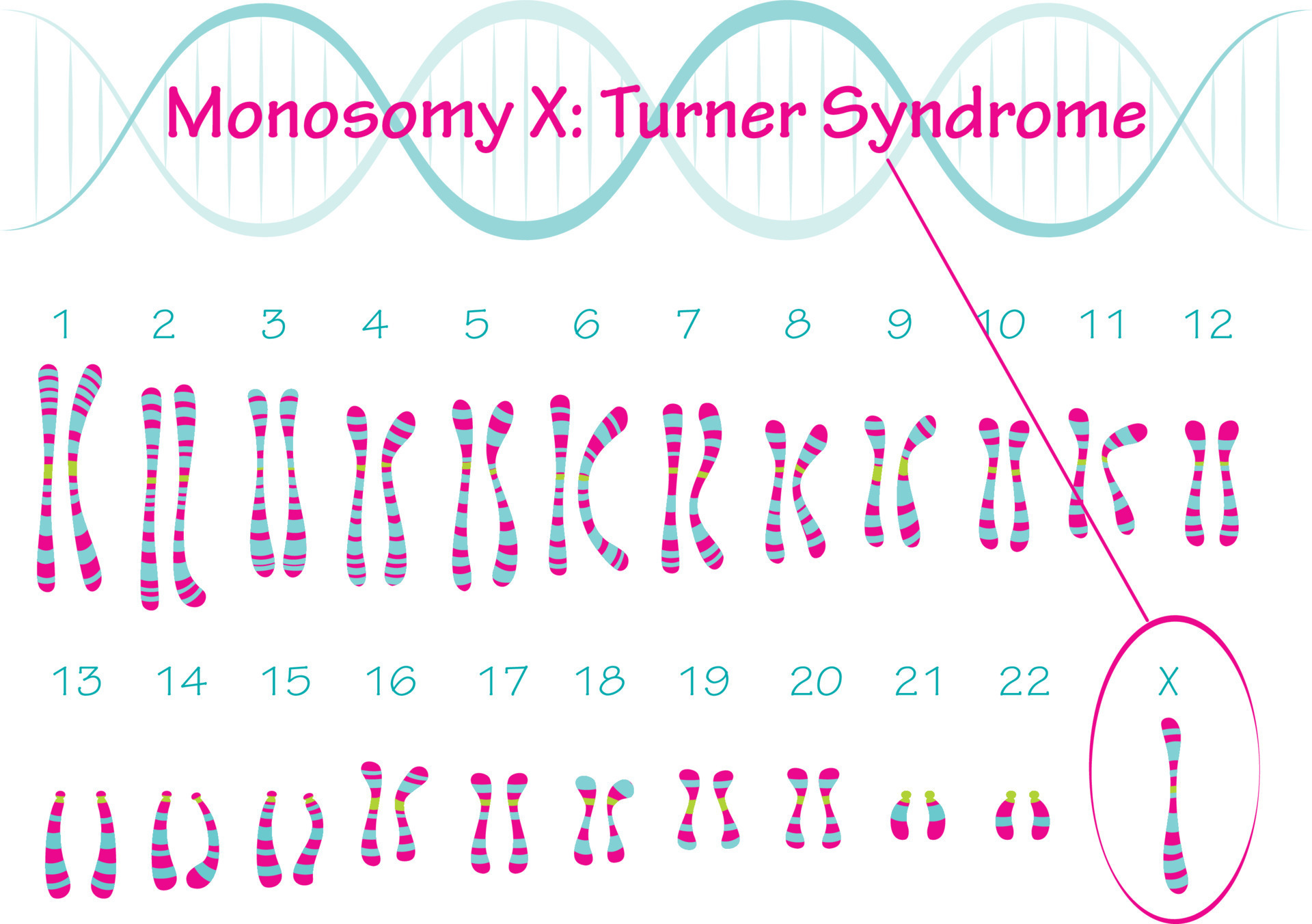 Turner Syndrome Karyotype Monosomy X Vector Art At Vecteezy