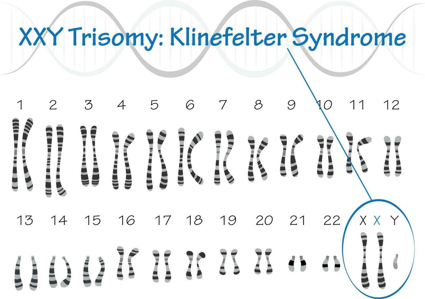 Klinefelter Syndrome Karyotype vector