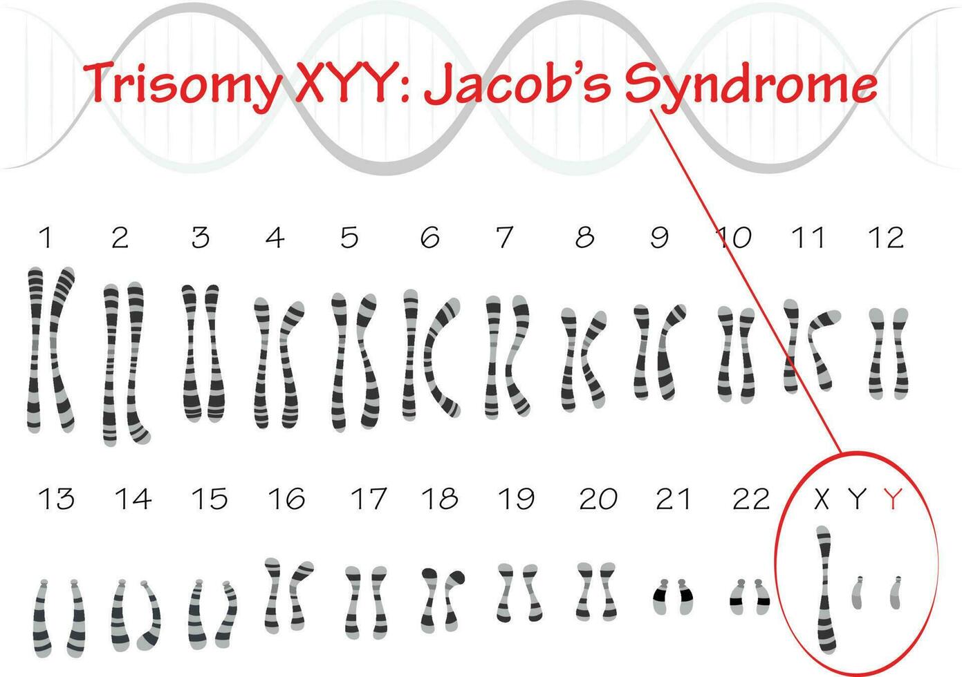 Trisomy XYY Jacobs Syndrome vector