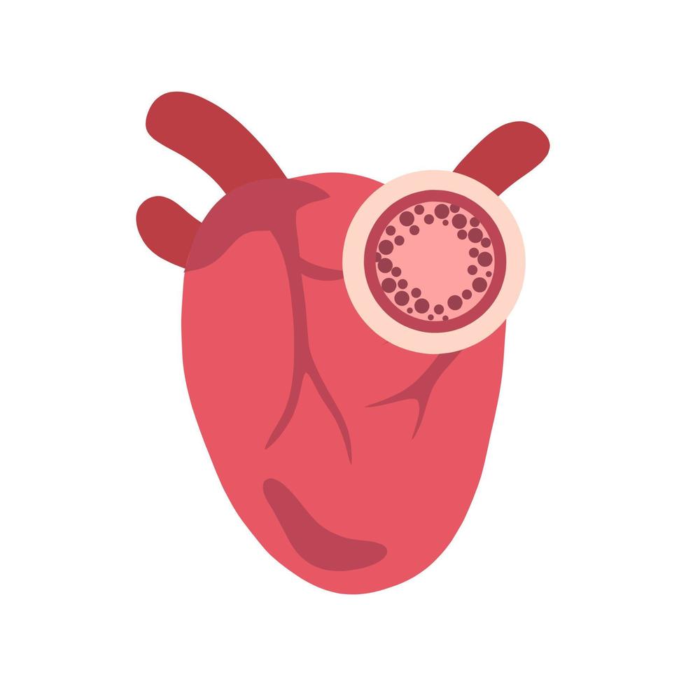 Heart with cholesterol flat illustration for health, medical, science, and education content vector