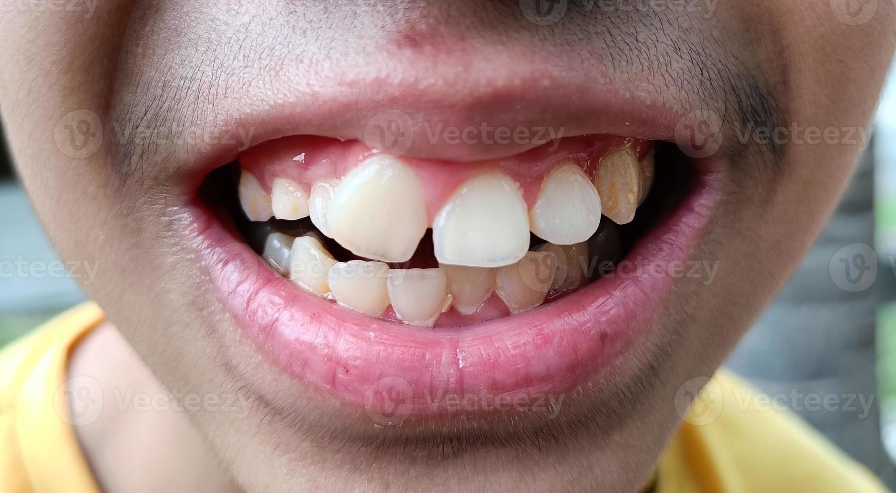 Crooked teeth of a young Asian boy photo