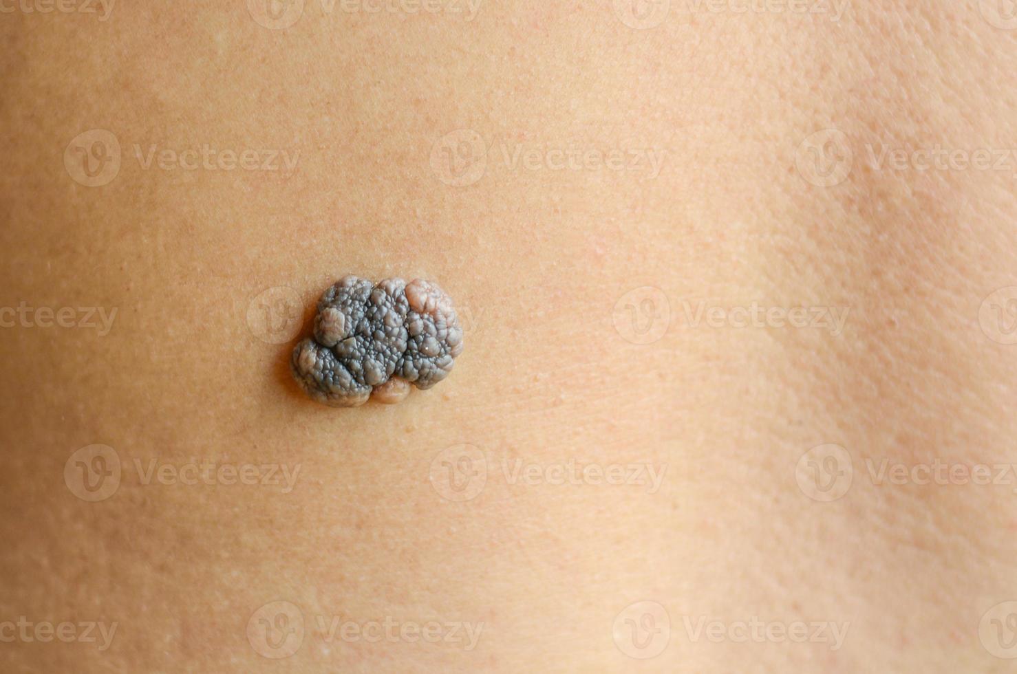 black mole on human skin photo