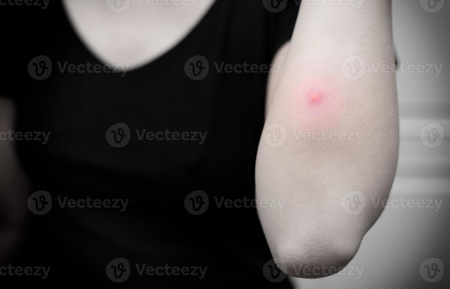 The inflammation of the swelling from abscess near woman elbow. Selective focus. Black and white tone photo