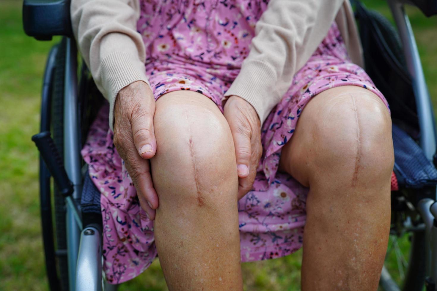 Asian elderly woman patient with scar knee replacement surgery in hospital. photo