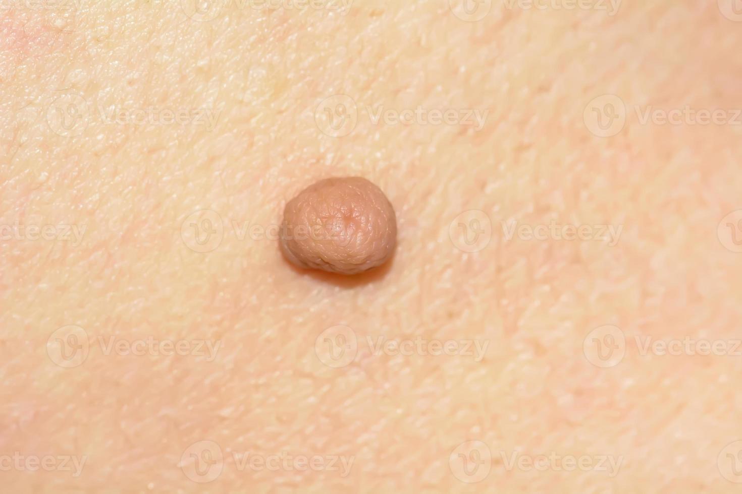 Skin tag or acrochondon or soft fibroma photo