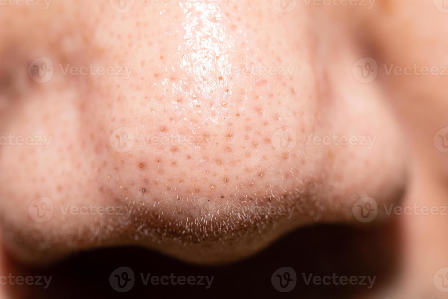 Pimples, clogged acne around the nose of men photo