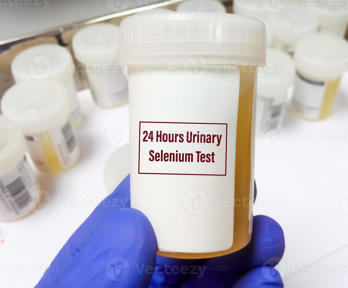 Laboratory scientist hand hold urine container with sample for 24 hours urinary selenium test. photo