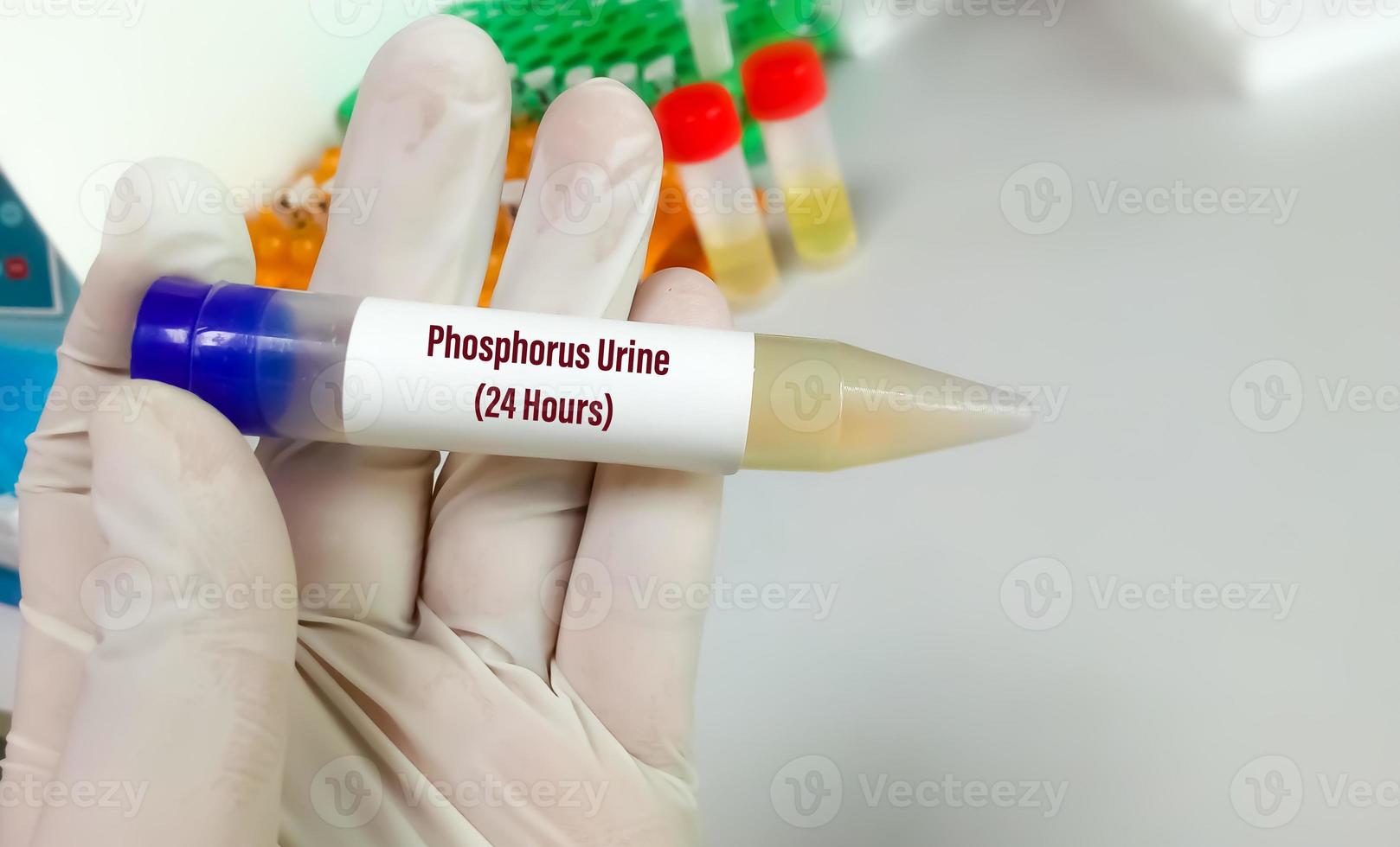 Biochemist hold urine sample for 24 hours urine Phosphorus test photo