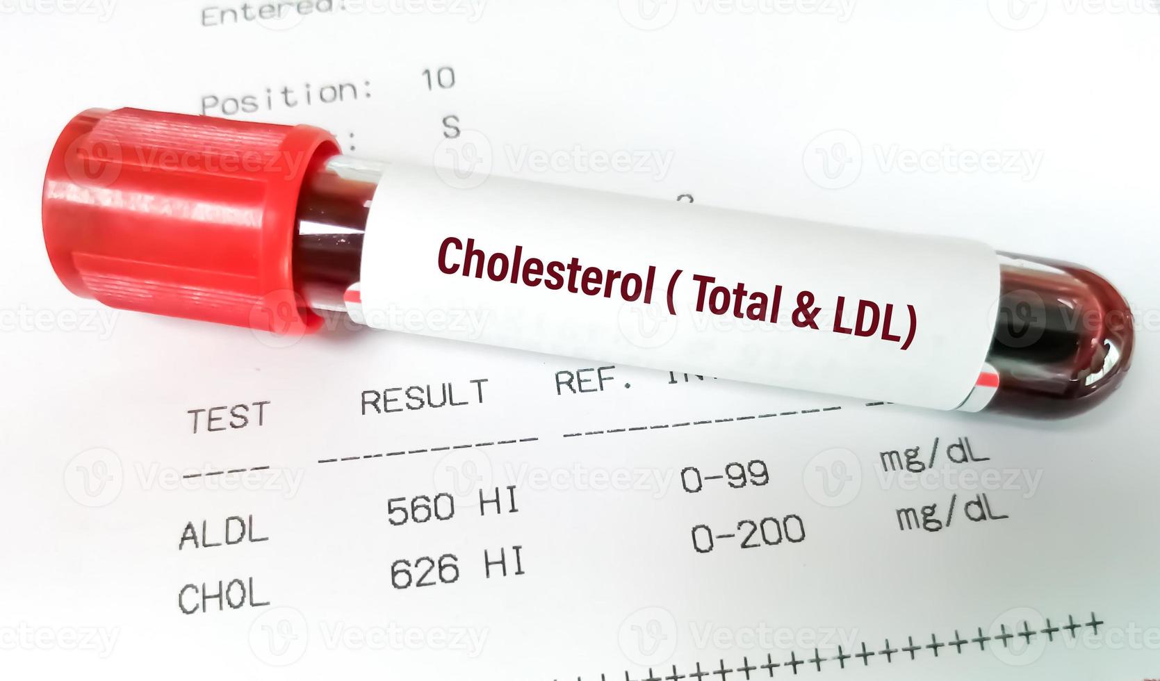 Blood sample with abnormal high report of cholesterol total and ldl cholesterol test. photo