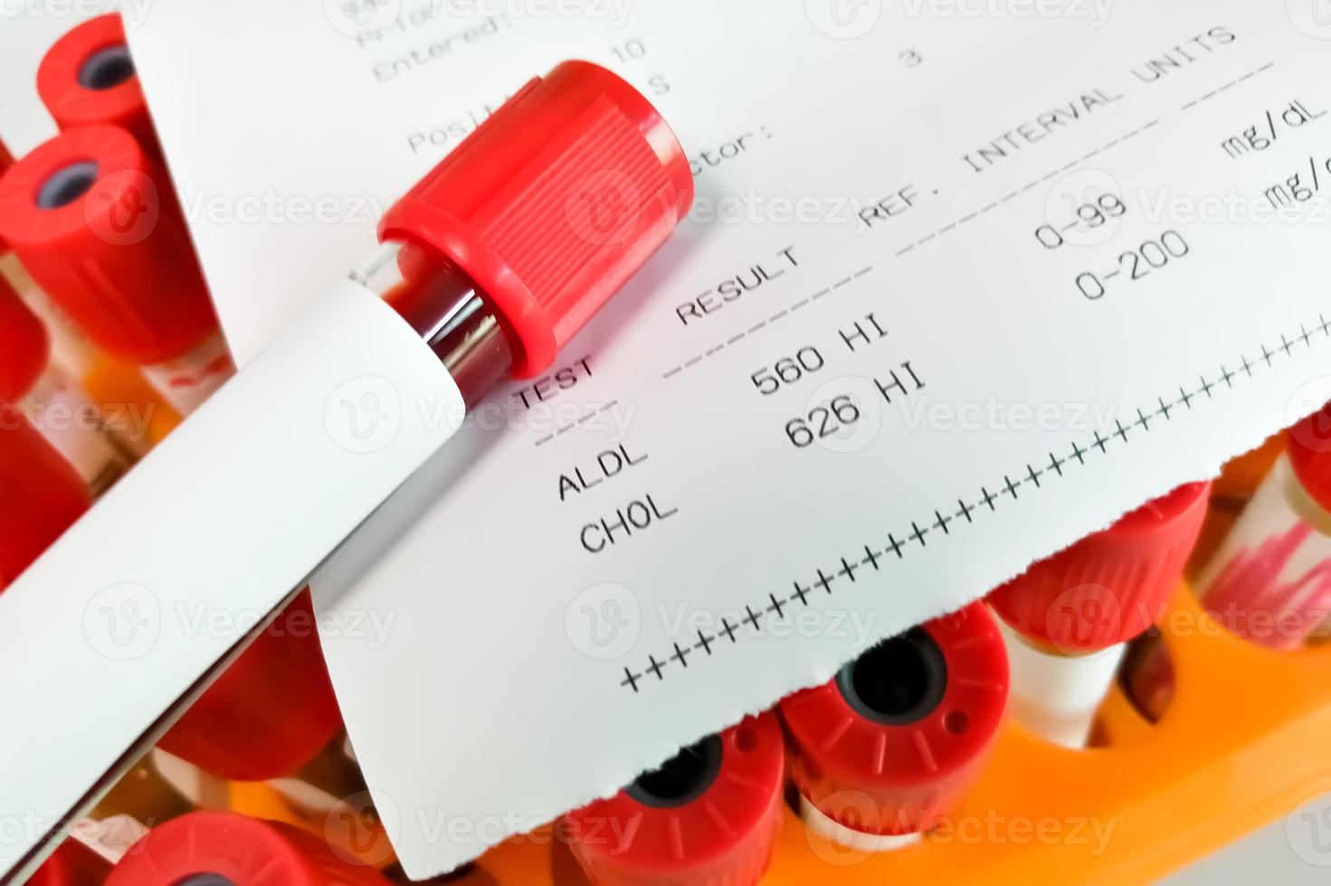 Blood sample with abnormal high report of cholesterol total and ldl cholesterol test. photo