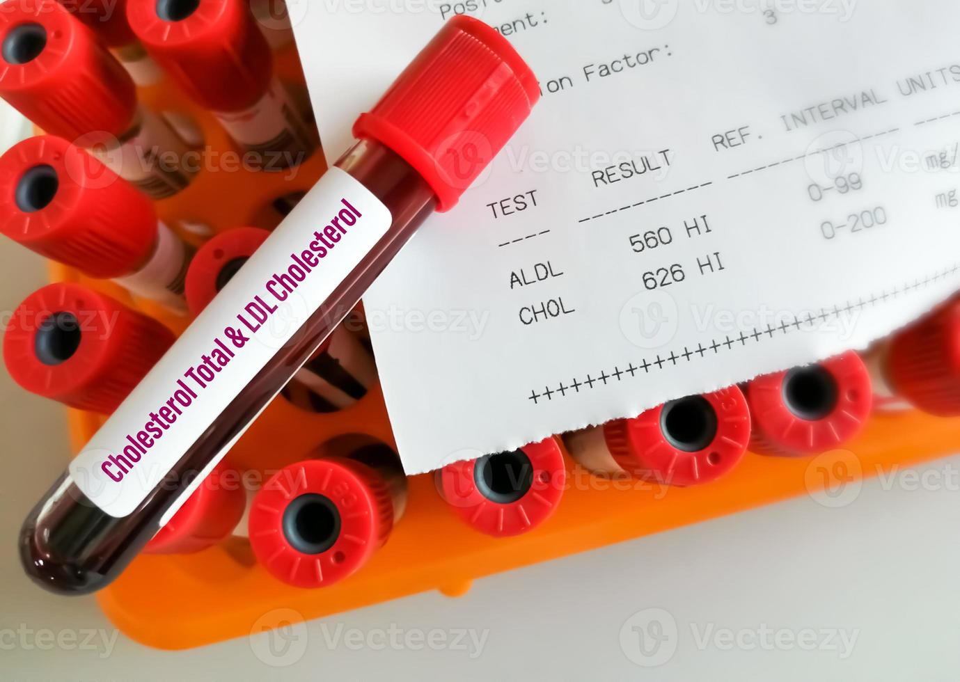 Blood sample with abnormal high report of cholesterol total and ldl cholesterol test. photo