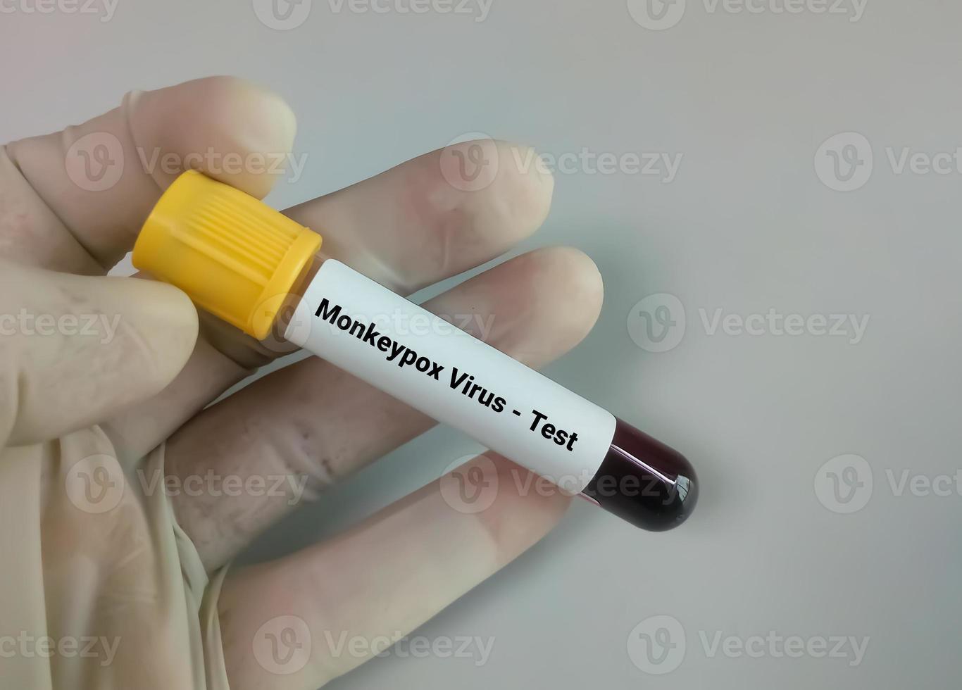muestra de sangre para la prueba del virus de la viruela del mono. foto