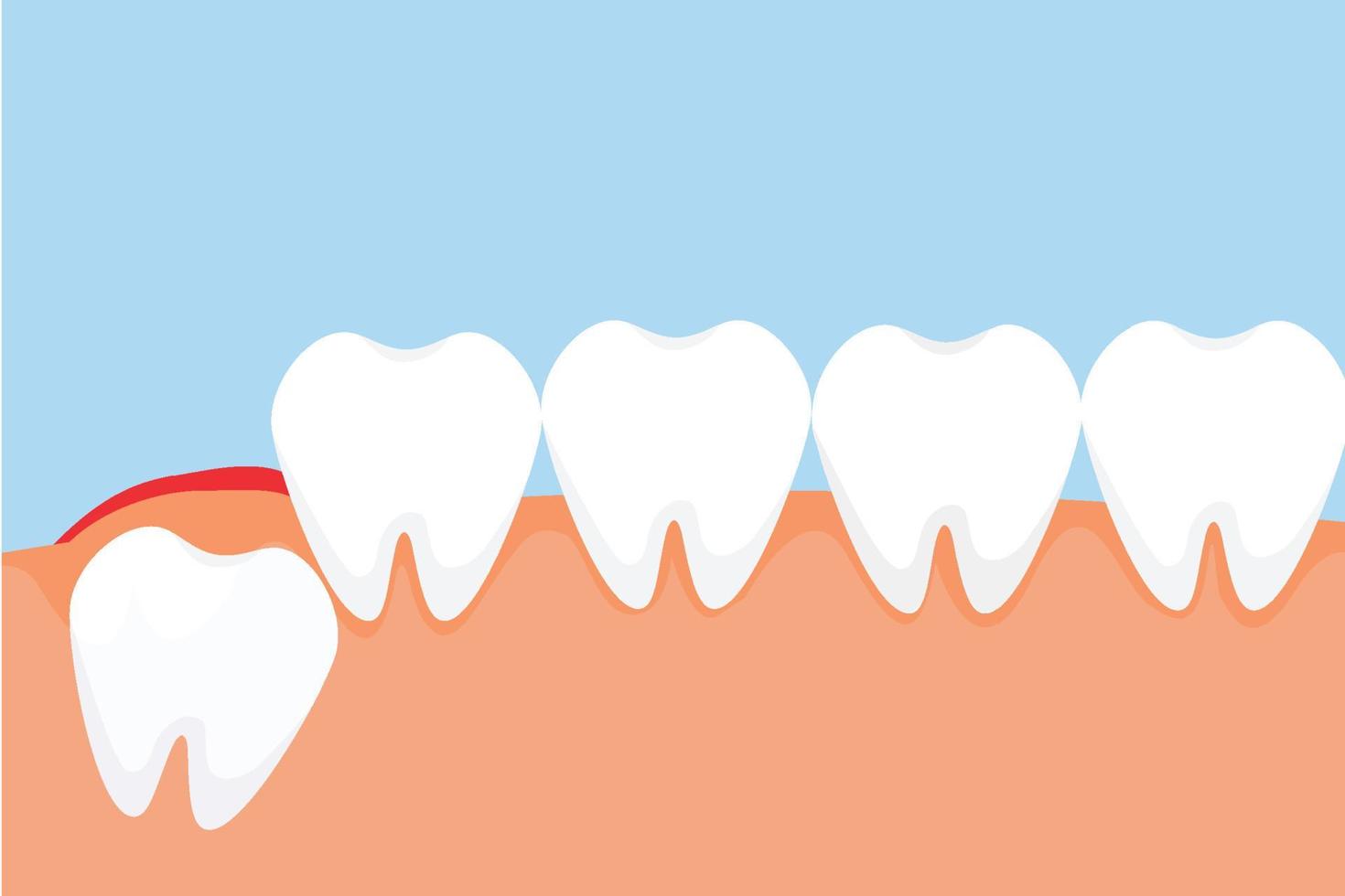 A wisdom tooth erupts through the gum and gives a red pain signal concept. Dangerous wisdom toothache causes gum pain vector. Tooth pushing from the inside and giving pain to the gum. vector