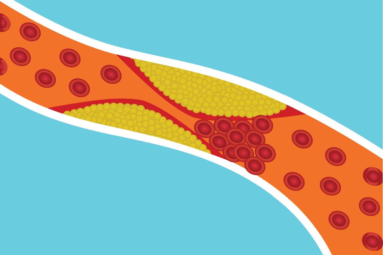 los vasos sanguíneos están bloqueados por grasa corporal adicional. los glóbulos rojos están bloqueados por grasa amarilla dentro de una arteria. ilustración vectorial del concepto de anatomía humana y coagulación de la sangre. enfermedades cardíacas. vector