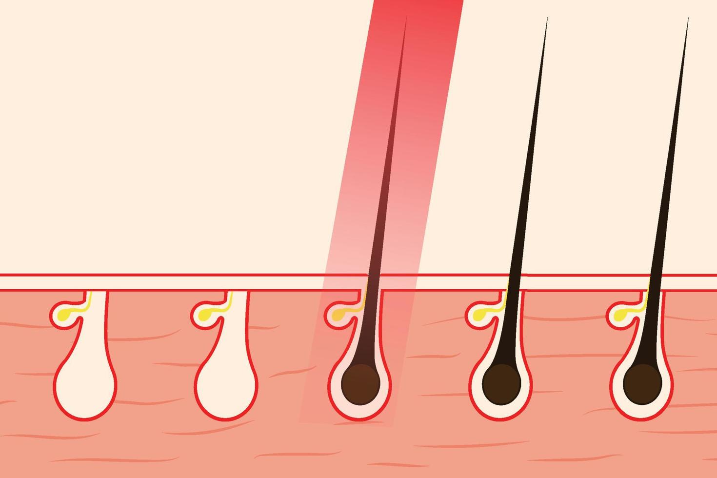 eliminar el vello con la ilustración del vector de luz láser roja. eliminar el vello corporal desde la raíz del cabello mediante el uso de un tratamiento con láser. salón de belleza trabaja información y vector de concepto de depilación.