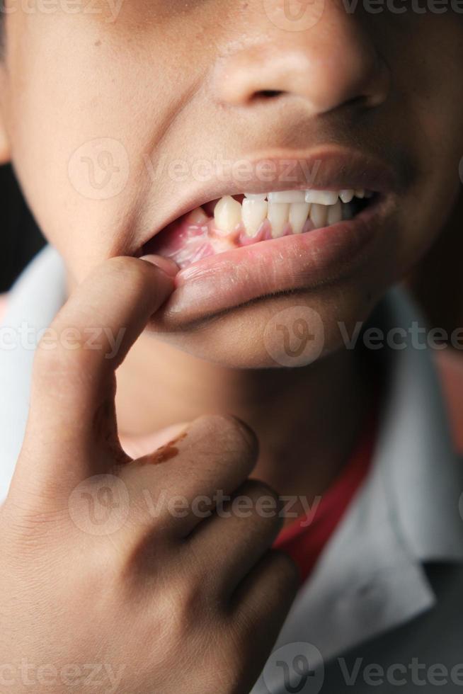 child with deformed teeth close up photo