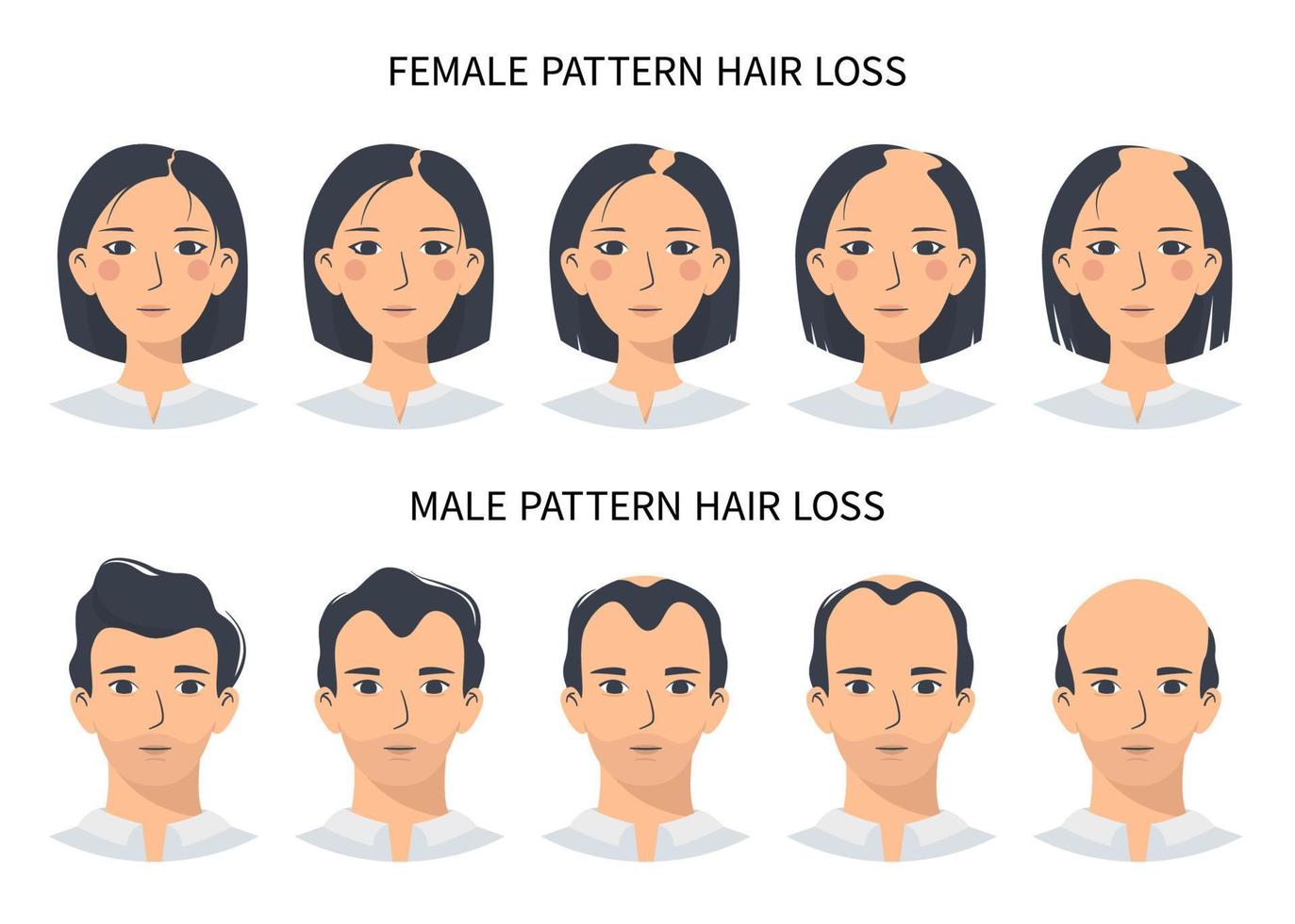 Etapas de pérdida de cabello, patrón de alopecia androgenética masculina y femenina. pasos de infografía vectorial de calvicie en un estilo plano con un hombre y una mujer. cambiar la línea del cabello en el cuero cabelludo vector