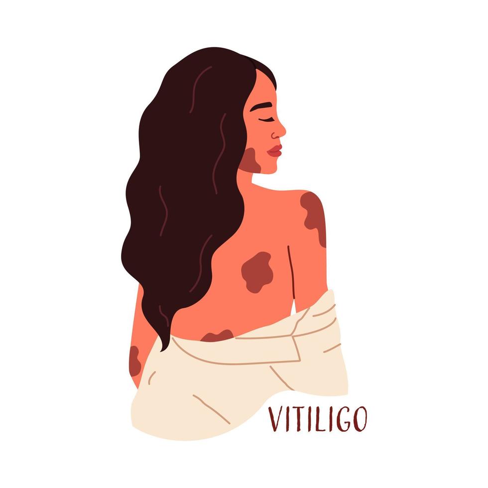 World Vitiligo Day. Beautiful woman with the skin disease vitiligo. Acceptance of your appearance, self-love. Vector illustration in flat style