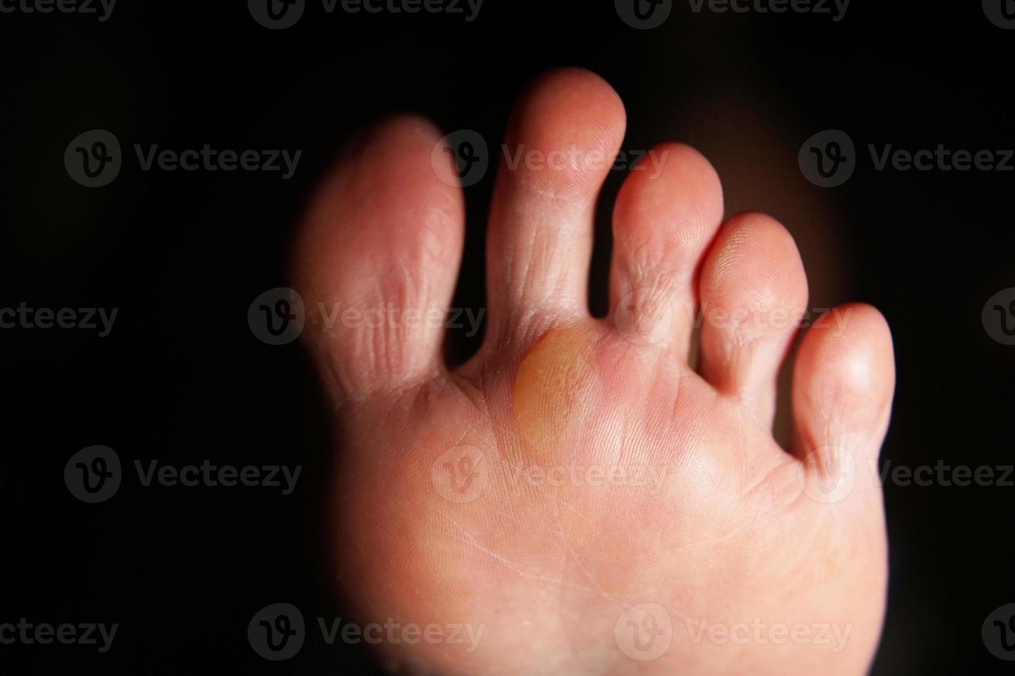 Blisters wounds feet caused by running barefoot. 8060091 Stock Photo at