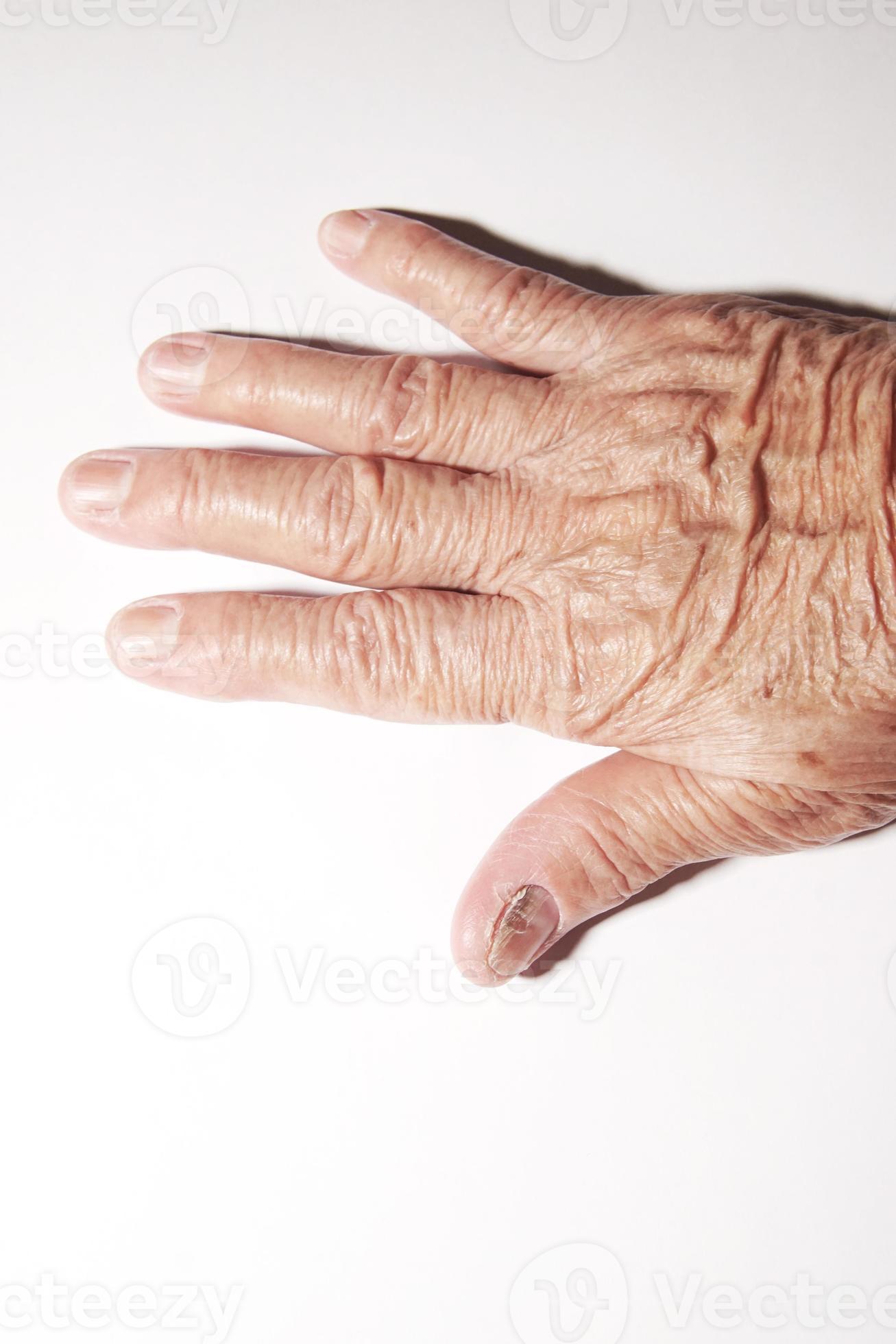 Fingernail of an elderly woman infected