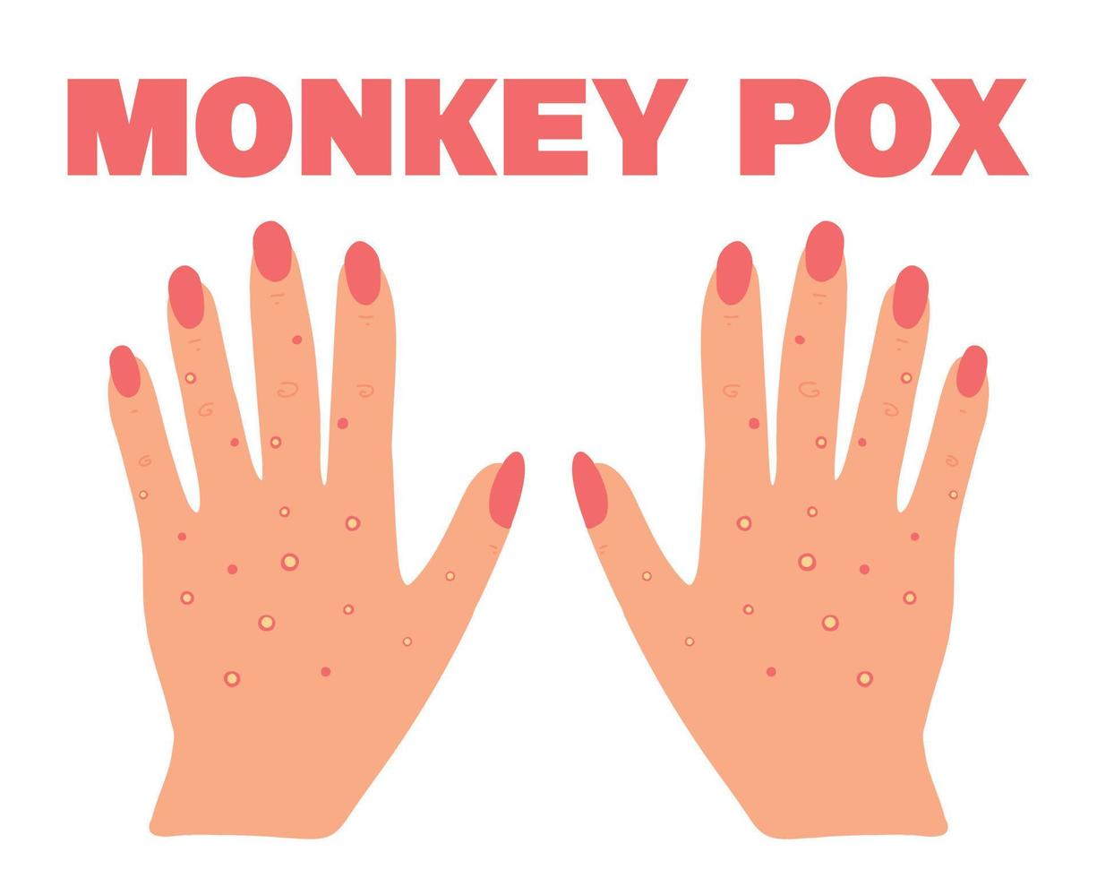 Banner with smallpox monkey. Monkey pox. Hands with a rash. Smallpox symptom. Vector illustration.