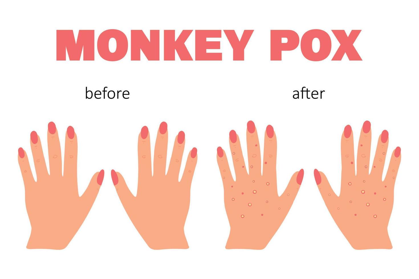Banner with smallpox monkey. Monkey pox. Hands with a rash. Smallpox symptom. Vector illustration.