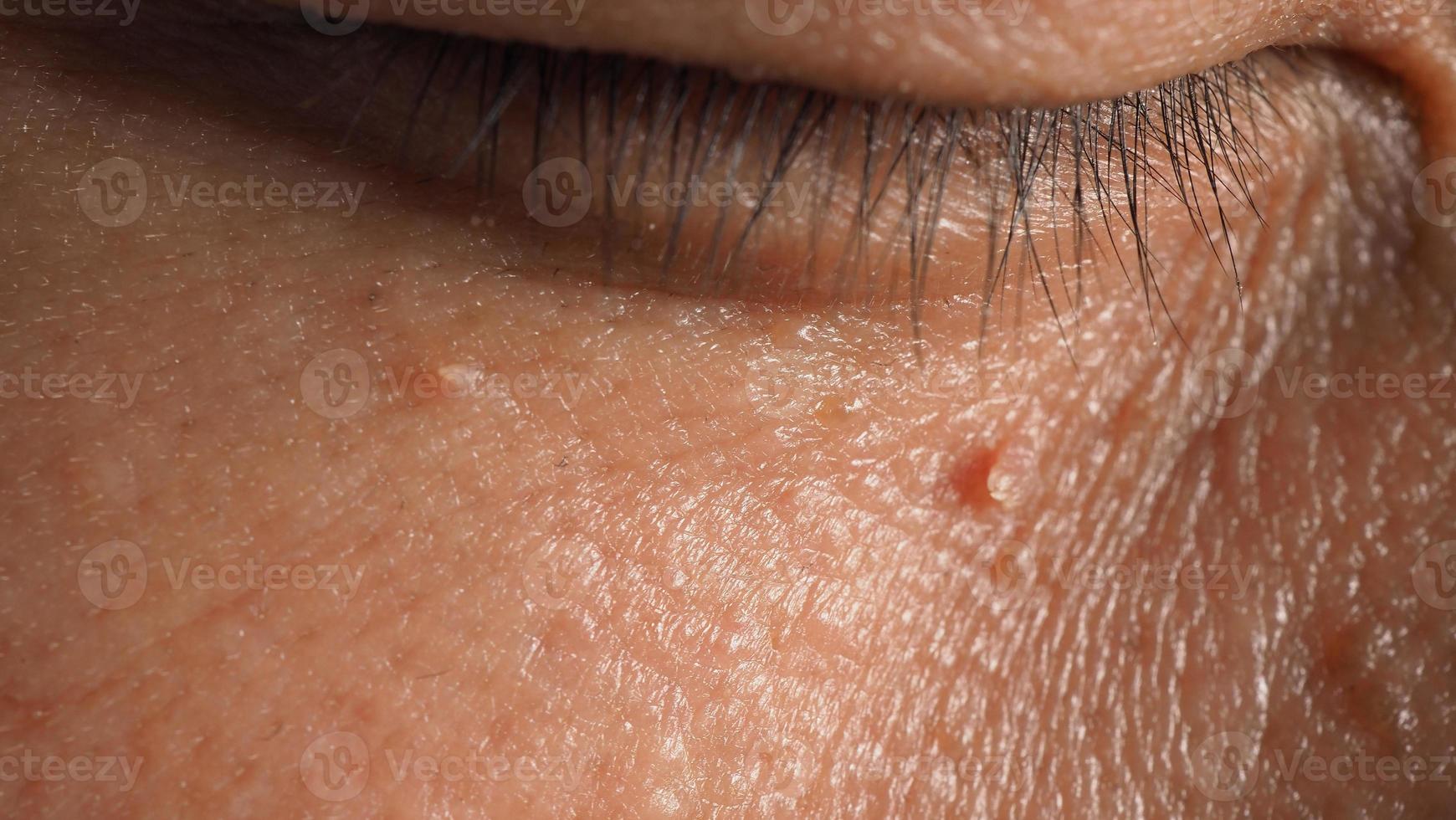 Wart skin removal. Macro shot of warts near eye on face. photo