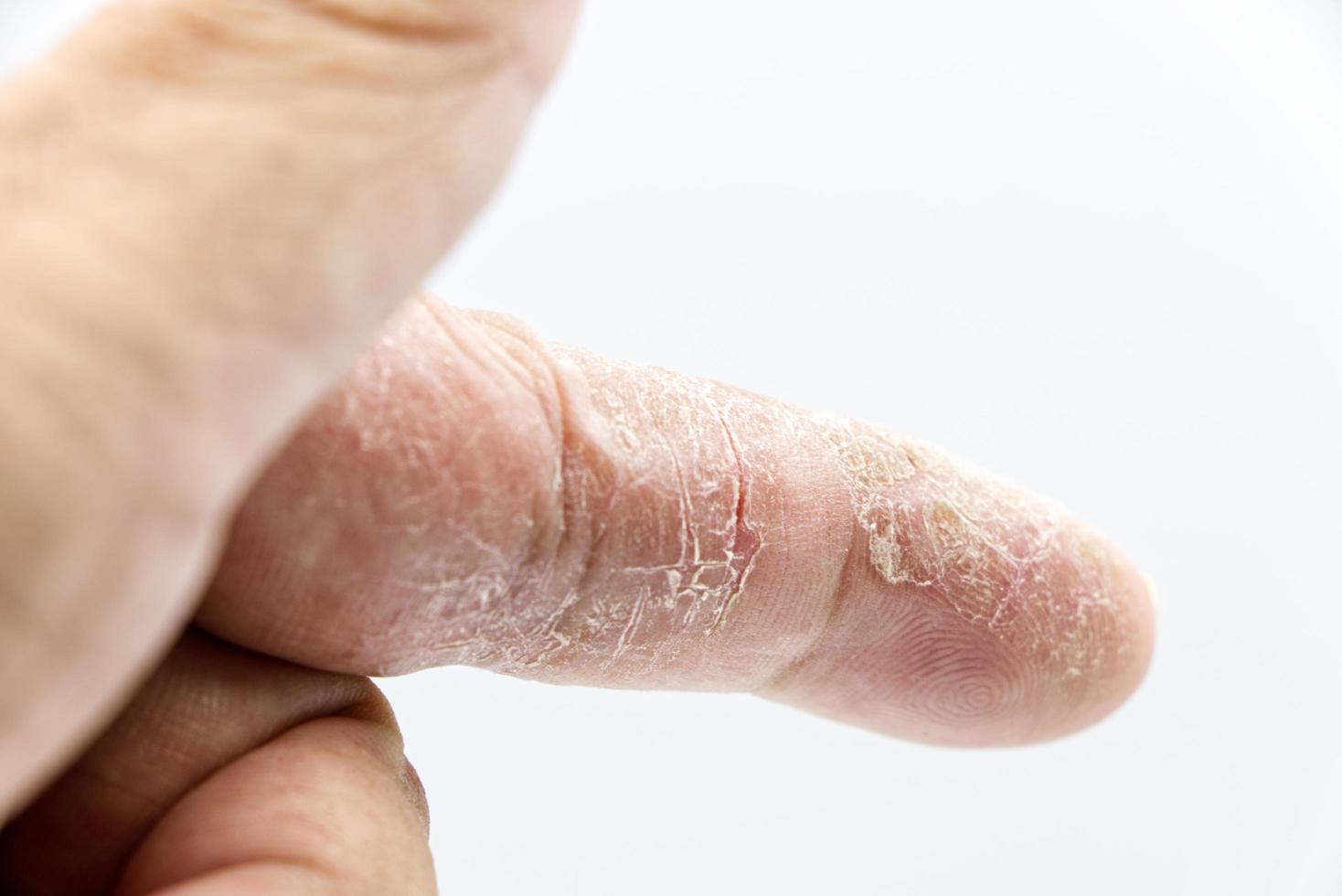 index finger skin disease on white background photo