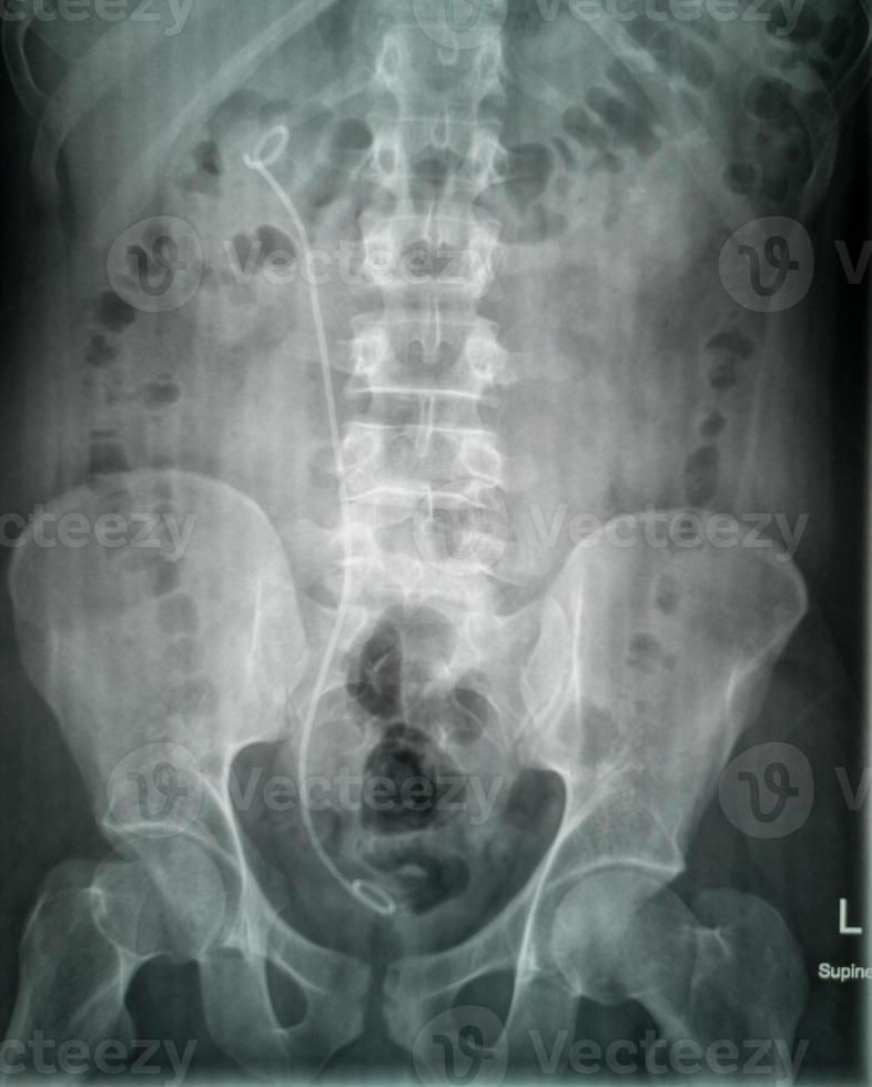 Plain X-Ray of urinary tract  anteroposterior view showing right ureteric stent used to treat stones photo