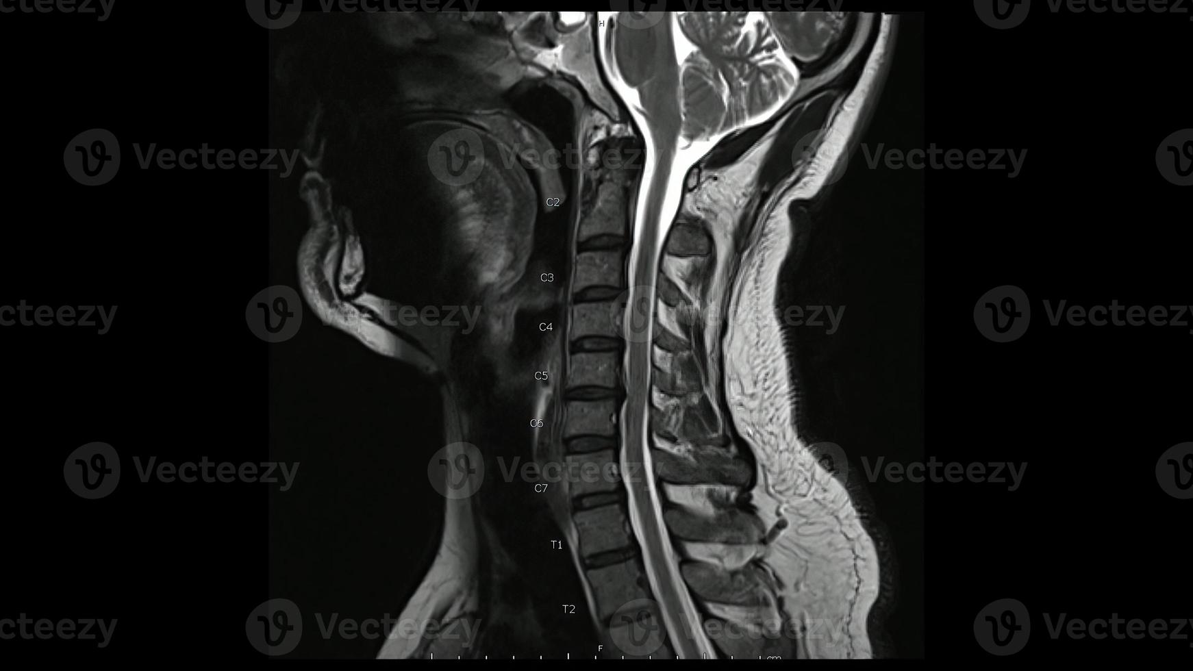 imágenes de resonancia magnética de la columna cervical Imagen sagital ponderada en t2, resonancia magnética de la columna cervical, que muestra una enfermedad de disco múltiple, más evidente en el disco c5-6. foto