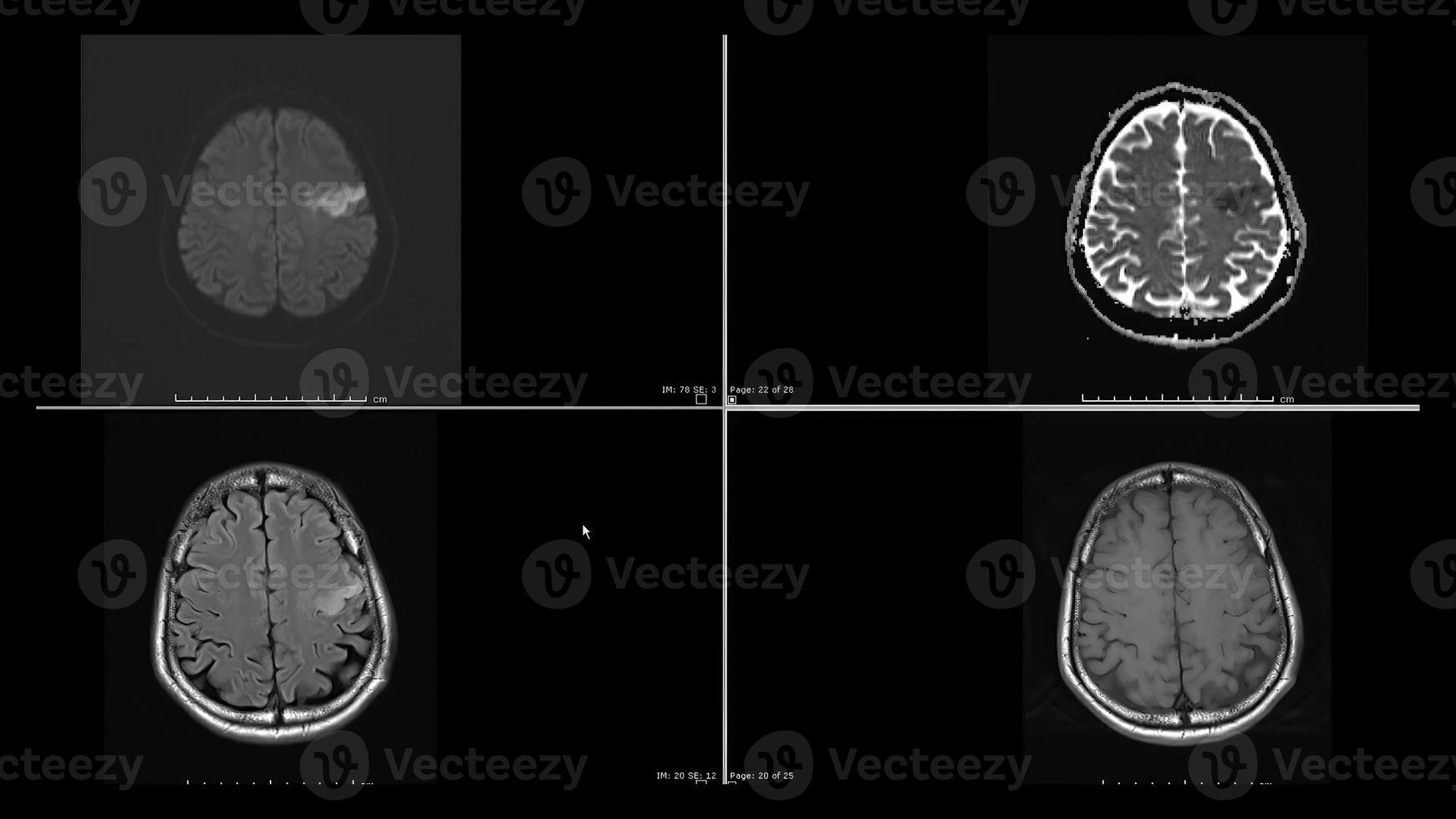 Magnetic resonance  images ,MRI, of brain infarction  in the left frontal lobe superior cuts photo