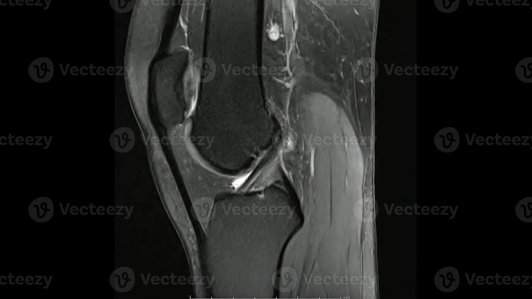 Magnetic Resonance images of  The Knee joint Sagittal Proton density Image  ,MRI Knee joint, showing the anatomy of the knee photo