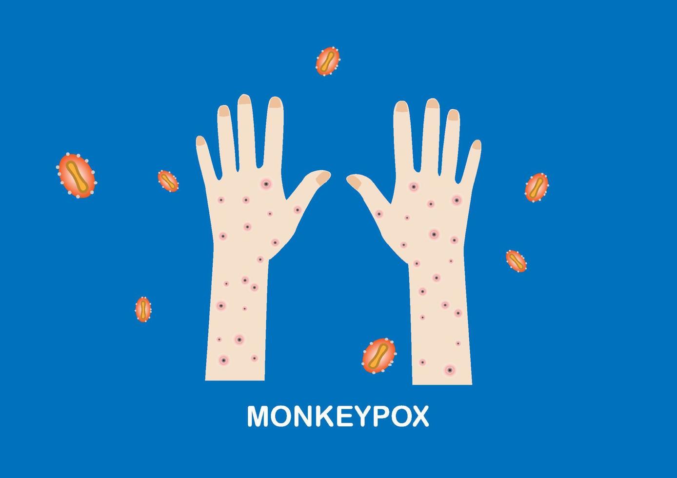 Illustration of rashes on hands and monkeypox viruses vector