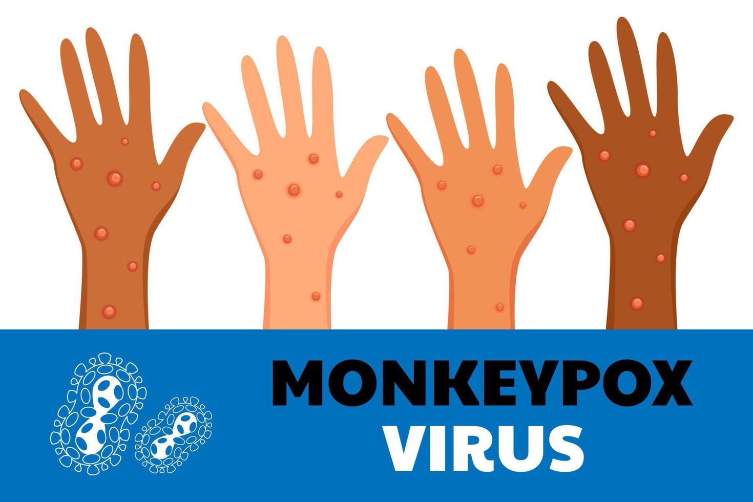 Monkeypox virus poster. Web banner of monkey pox skin infection of person. Vector Illustration.