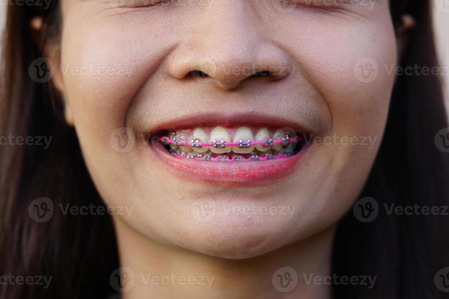 Asian women smile with beautiful braces. photo