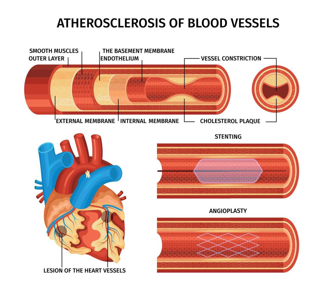 Realistic Atherosclerosis Infographic vector