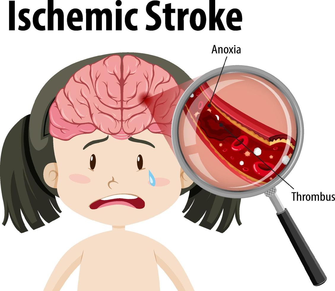 humano con accidente cerebrovascular isquémico vector