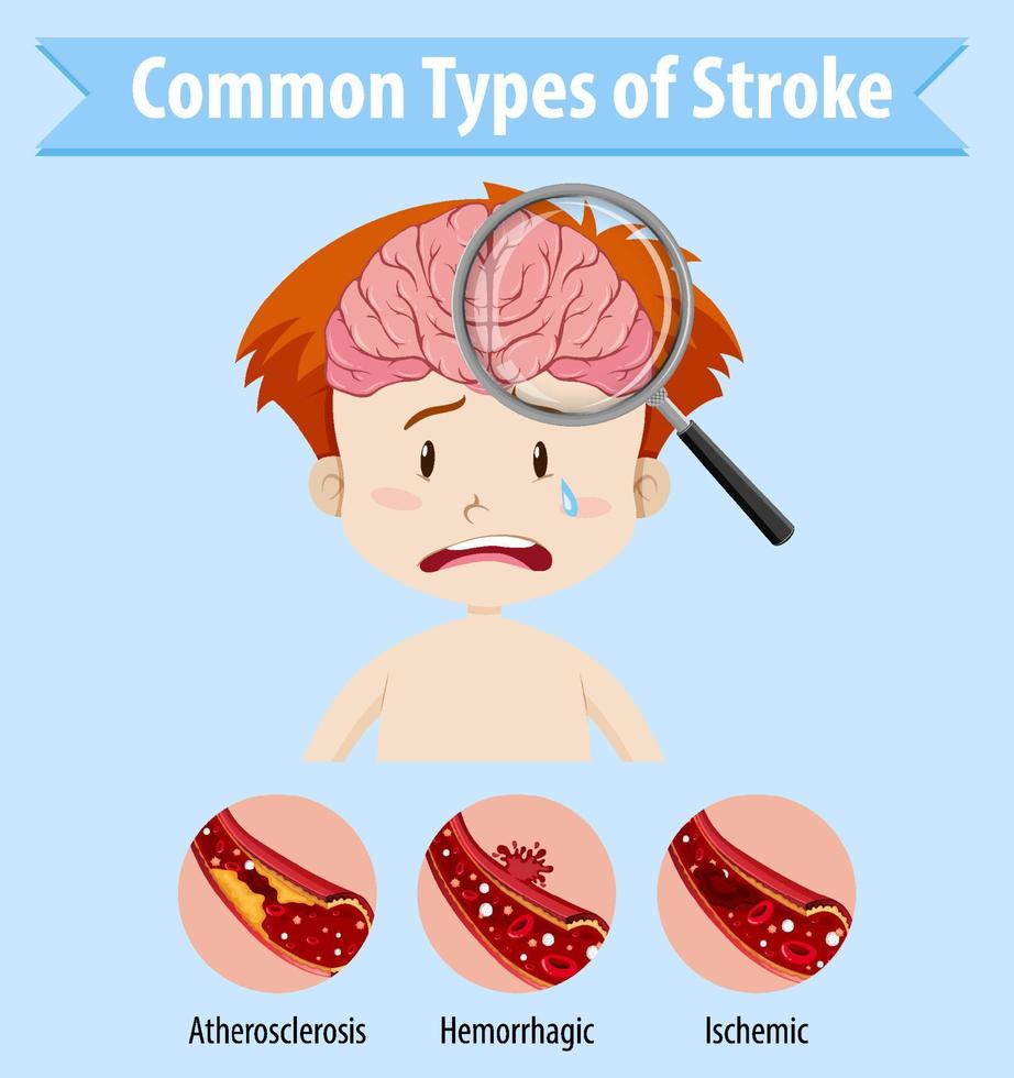 Human with common types of stroke vector