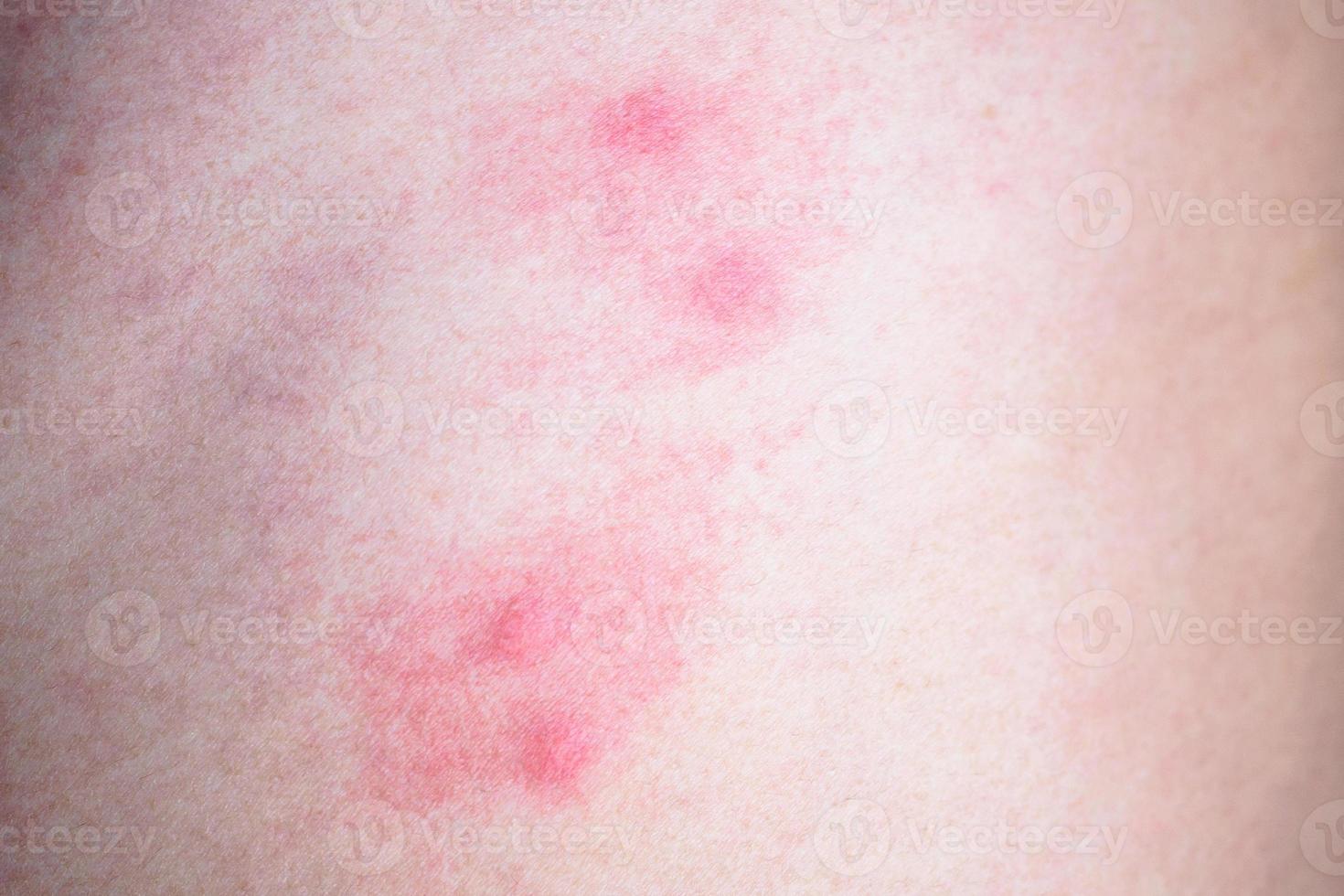 alergia en la piel por picaduras de mosquitos foto