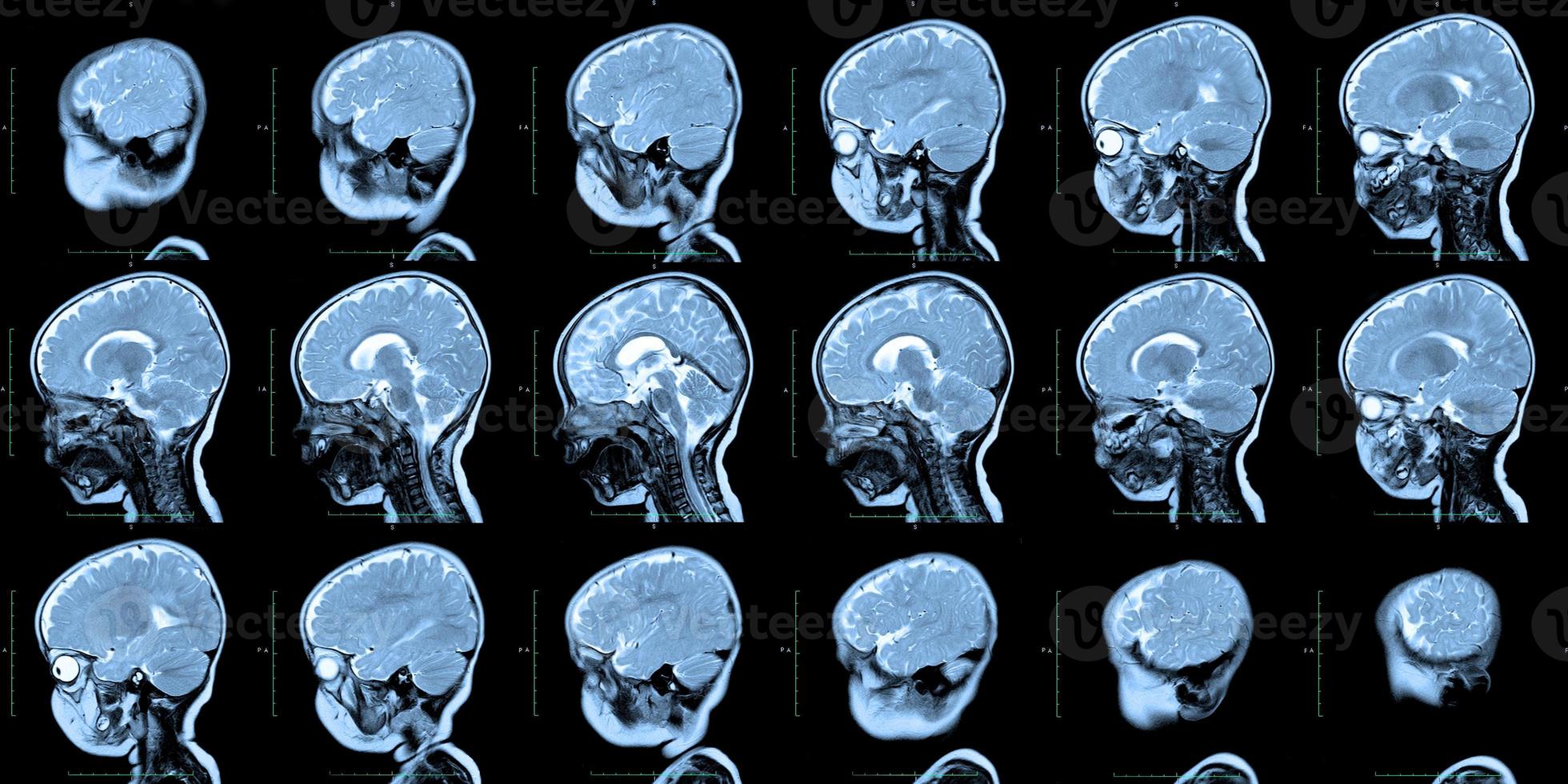 MRI scan of the human skull and brain, with malformations of the brain, preliminary diagnosis, Holoproencephaly, absence, agenesis of the transparent septum, one year old boy, side view. photo