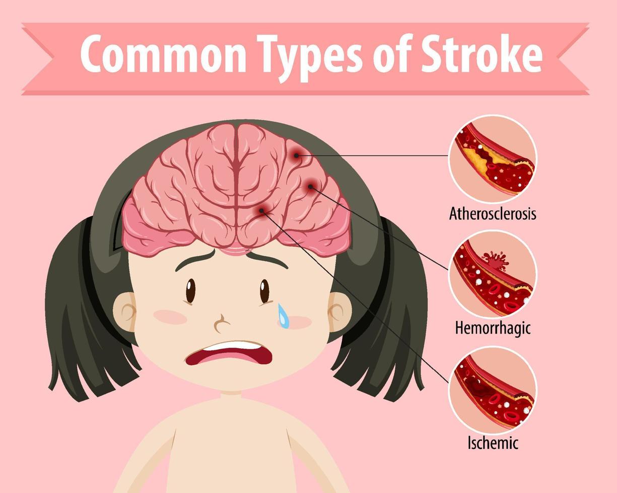 Human with common types of stroke vector