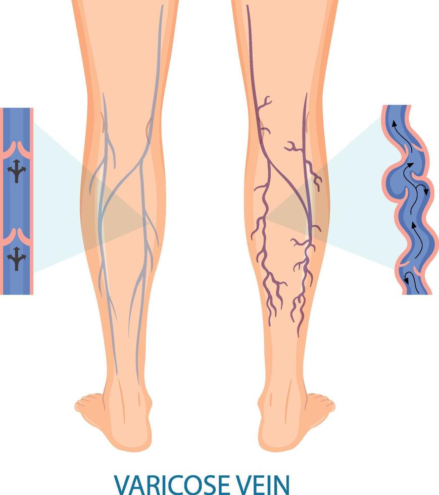 piernas humanas con vena varicosa vector